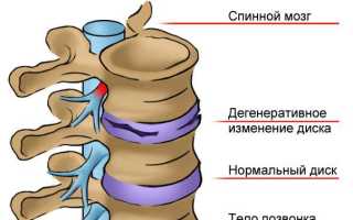 Как делают массаж при остеохондрозе с корешковым синдромом
