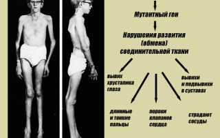 Синдром марфана фото что это такое