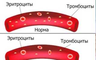 Лекарственная тромбоцитопения код мкб