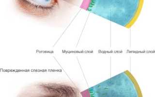 Причины и лечение синдрома сухой глаз