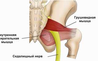 Синдром грушевидной мышцы лечение в домашних
