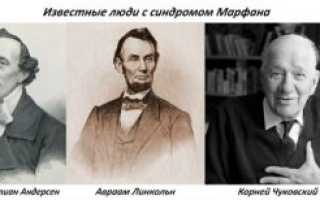 Новорожденный с синдромом марфана фото