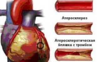 Сердечная недостаточность острый коронарный синдром