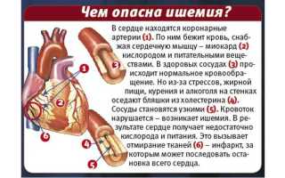 Безболевая ишемия код мкб