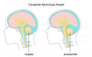 Причины возникновения синдрома арнольда киари