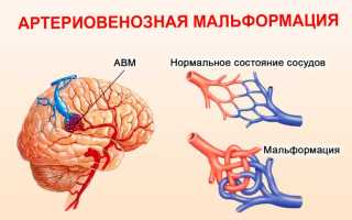 Мальформация головного мозга код мкб