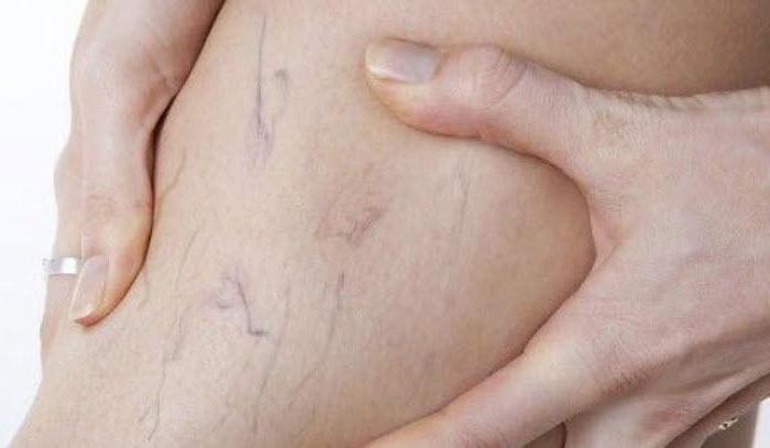 детралекс побочные эффекты при использовании 