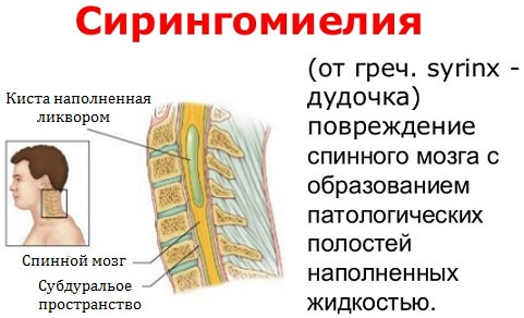Причины возникновения синдрома арнольда киари