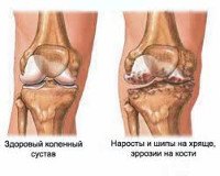 M17 Гонартроз [артроз коленного сустава]