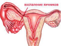 N70.1 Хронический сальпингит и оофорит