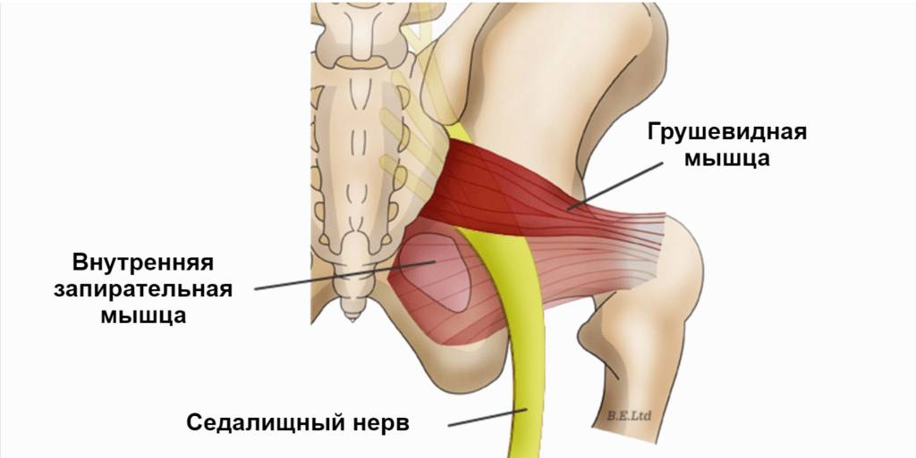 Синдром грушевидной мышцы лечение в домашних