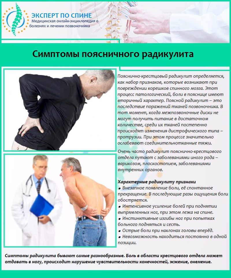 Симптомы поясничного радикулита