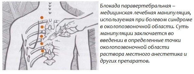 Блокада паравертебральная