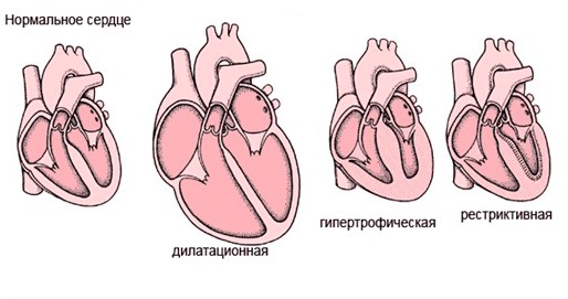 Код мкб функциональная кардиопатия