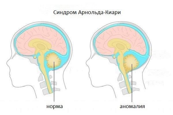 Причины возникновения синдрома арнольда киари