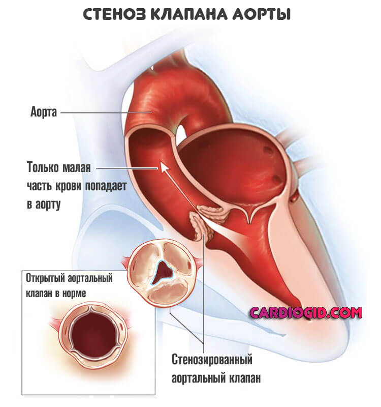 аортальный-стеноз