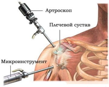 Преимущества артроскопии