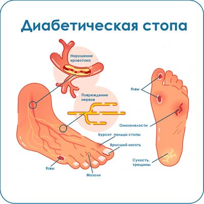 Сестринский уход при синдроме диабетическая стопа