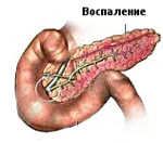 Билиарный панкреатит