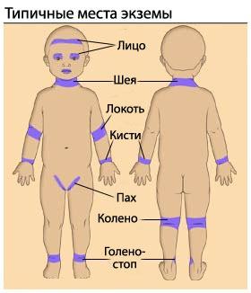 Локализация очагов поражения при экземе