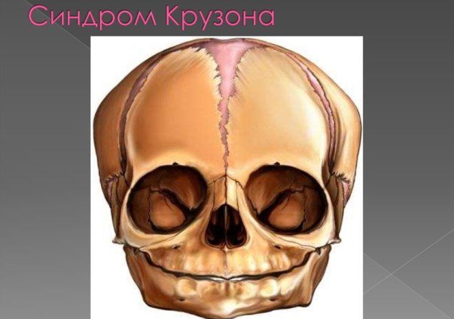 синдром крузона что это