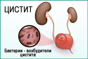 Бактериальный цистит