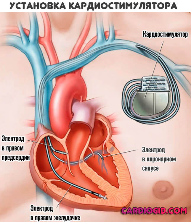 kardiostimulyator