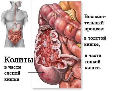 Локализация колита в слепой кишке