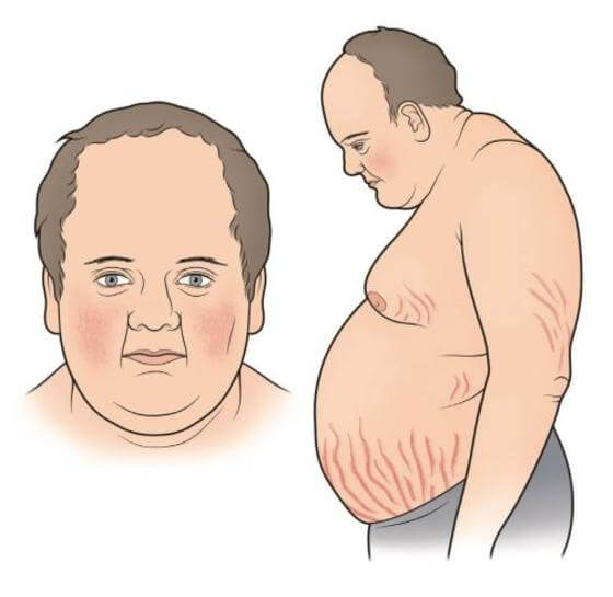 Синдром кушинга у ребенка фото