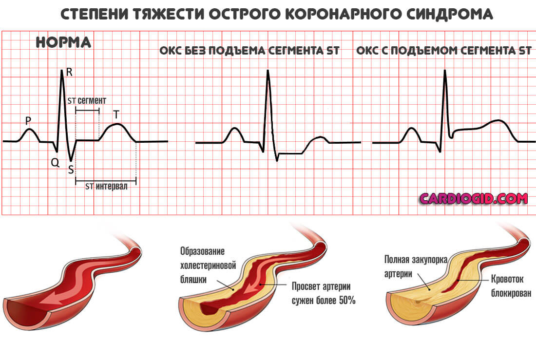 окс-с-подъемом-сегмента-st
