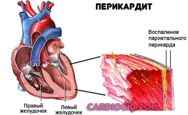 перикардит
