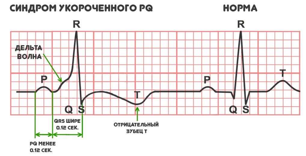 Синдром укороченного pq мкб 10