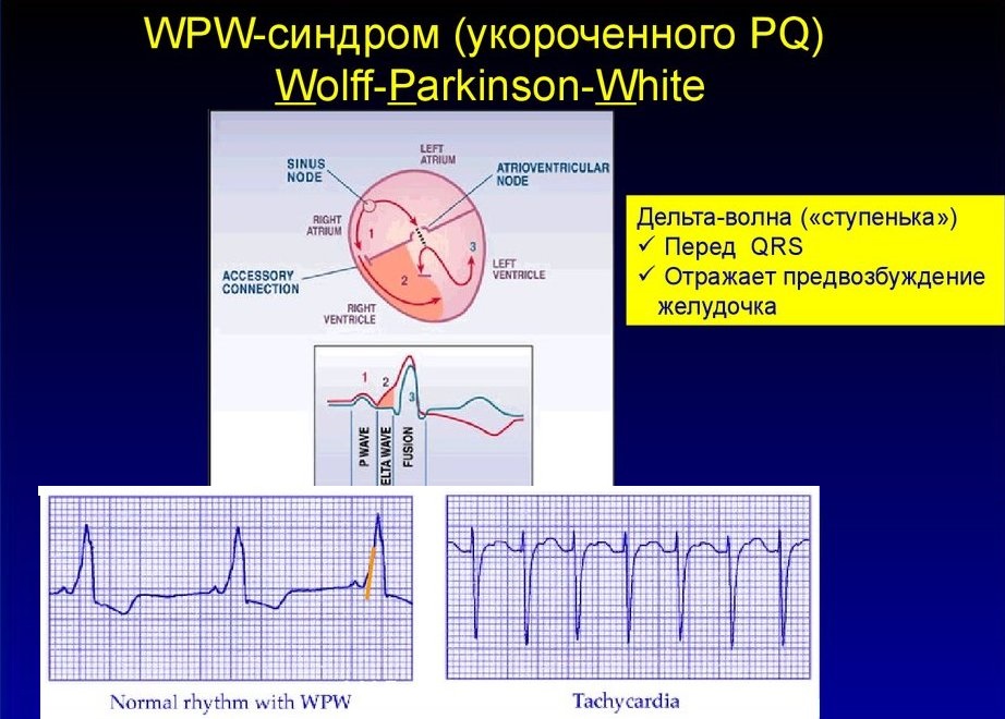 Синдром укороченного pq мкб 10