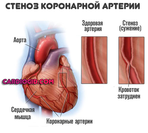 стеноз-коронарной-артерии
