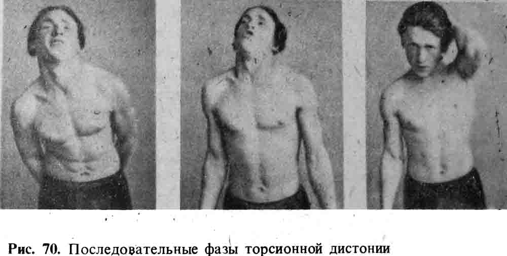 Последовательные фазы при торсионной дистонии
