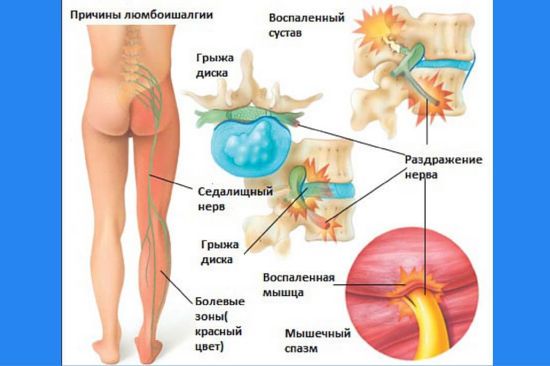 Развитие люмбоишиалгии